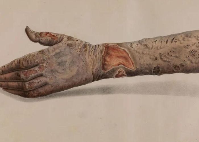 Sejarah Hari Kusta Internasional: Upaya Perawatan dan Pencegahan Penularan Penyakit Kusta