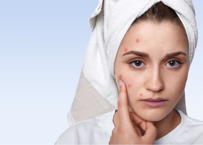 7 Penyebab Jerawat Sulit Hilang, Salah Satunya Karena Pola Makan Tidak Sehat