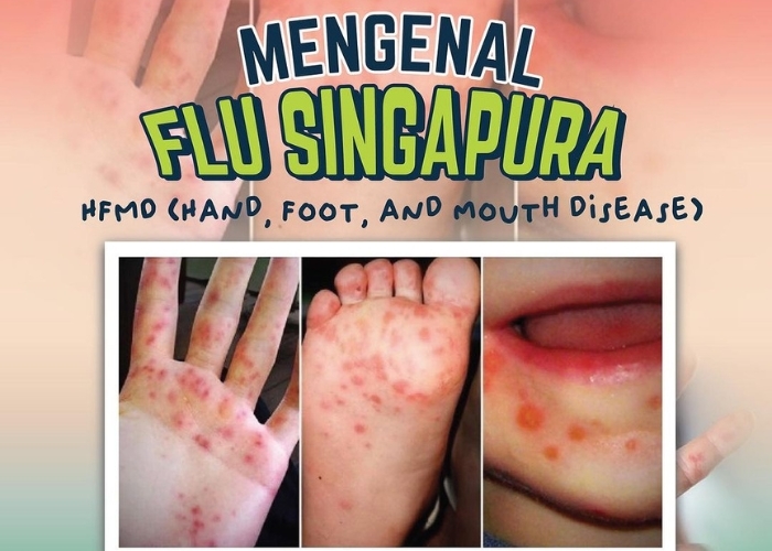 Waspada Flu Singapura! Kenali Beberapa Gejala, Penyebaran, serta Cara Pencegahan Penularan Penyakit Ini